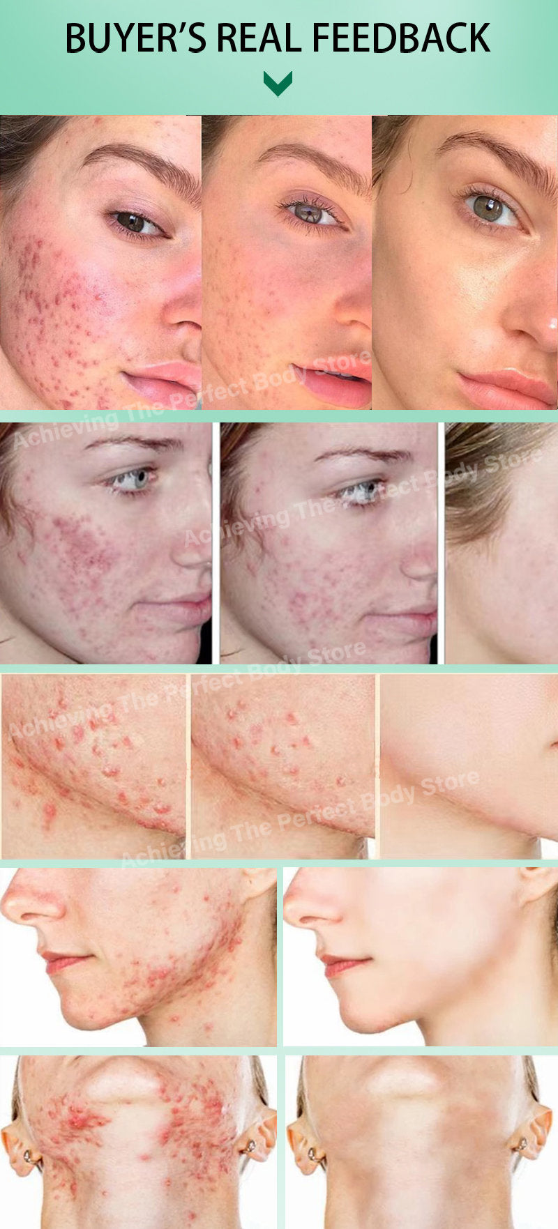 Creme para acne e espinha