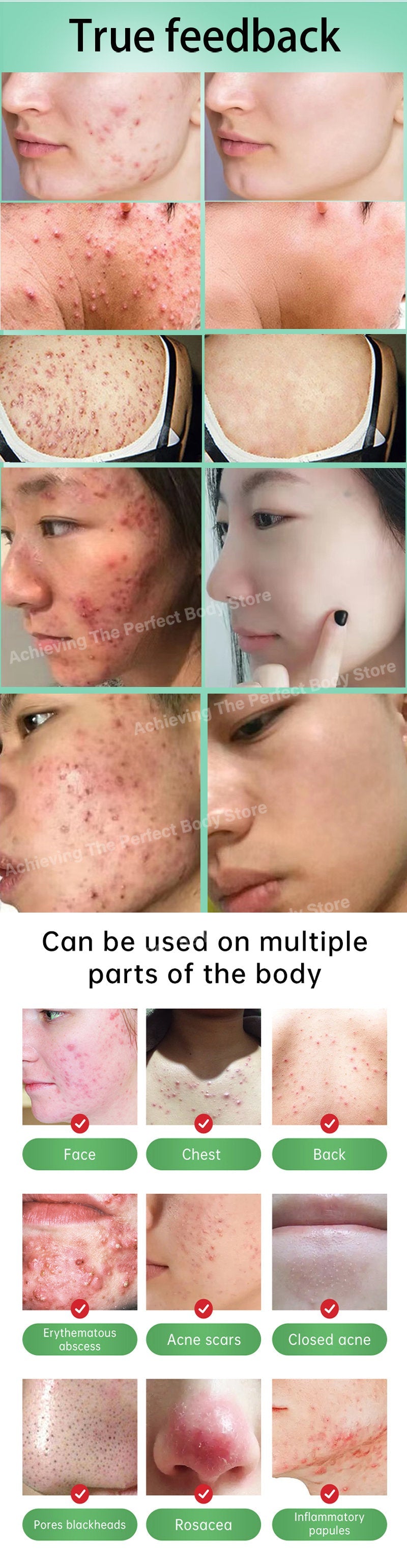 Creme para acne e espinha