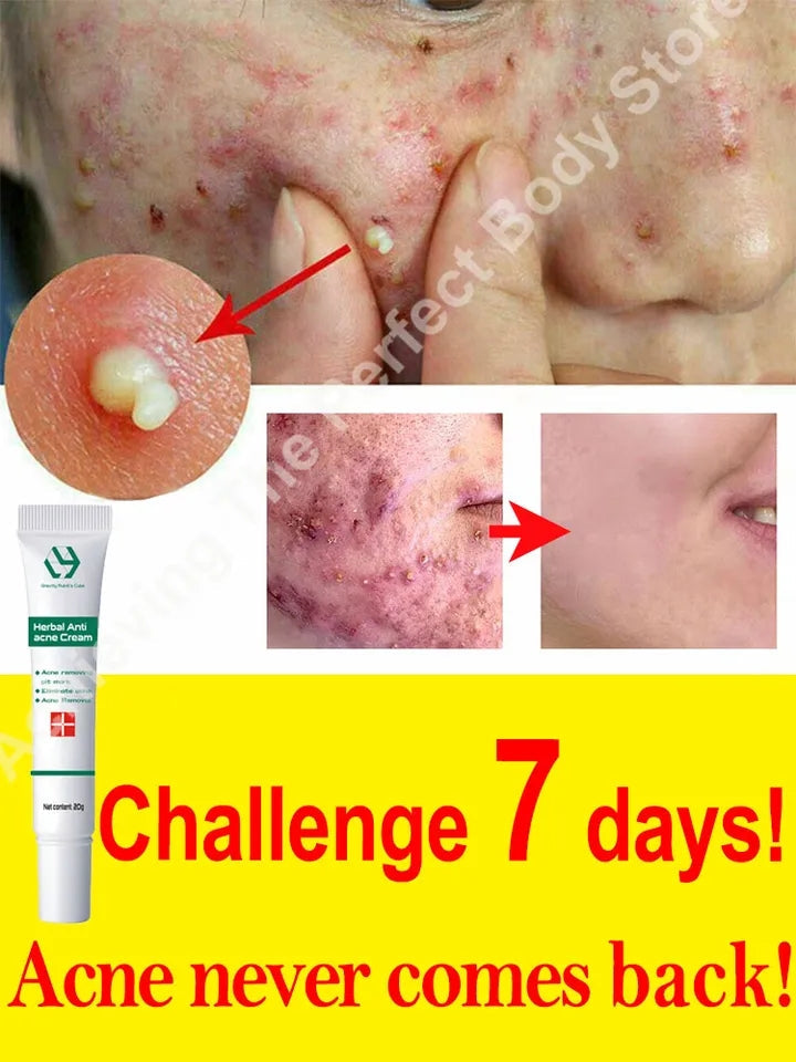 Creme para acne e espinha