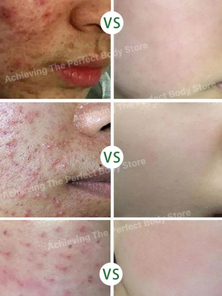 Creme para acne e espinha