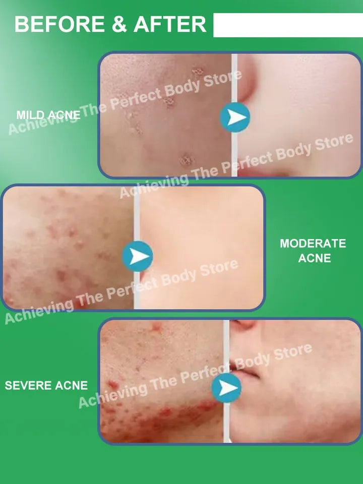 Creme para acne e espinha
